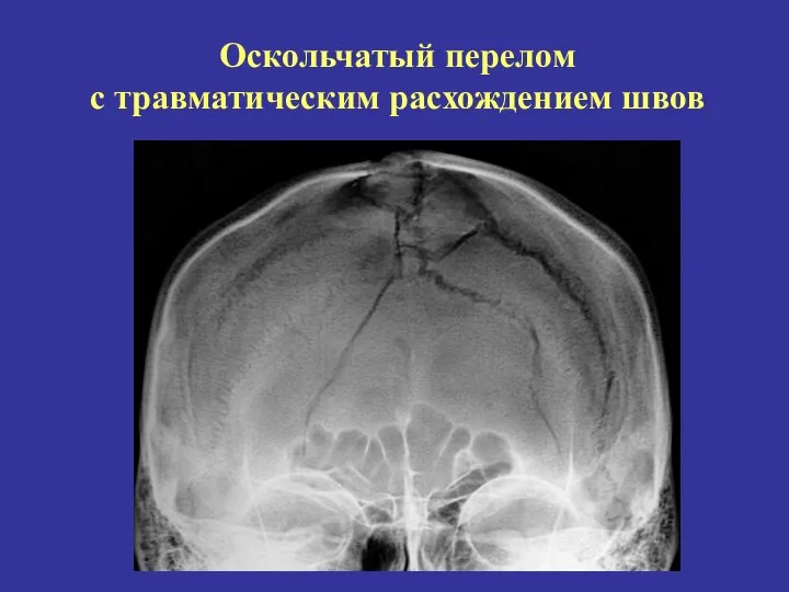 Оскольчатый перелом с травматическим расхождением швов