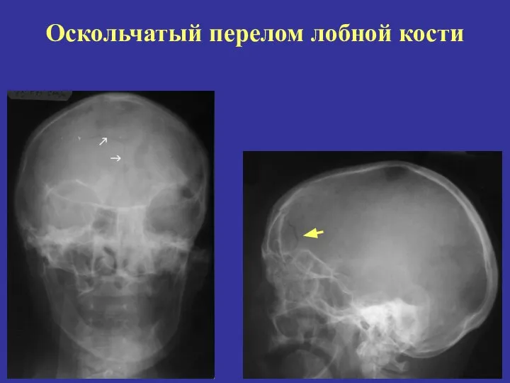 Оскольчатый перелом лобной кости