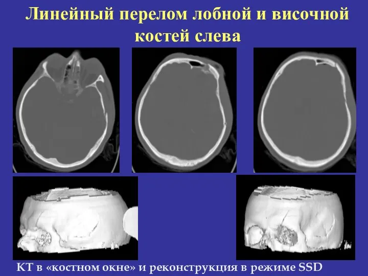 КТ в «костном окне» и реконструкция в режиме SSD Линейный перелом лобной и височной костей слева