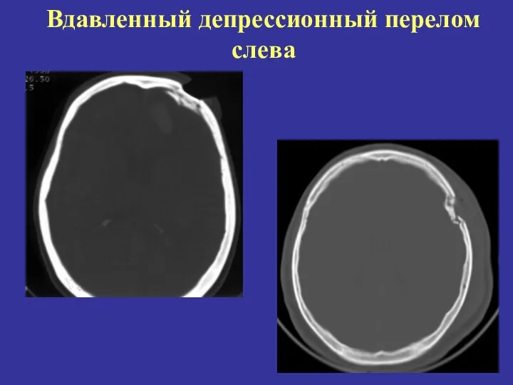 Вдавленный депрессионный перелом слева