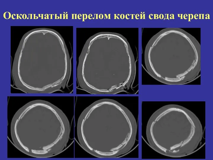 Оскольчатый перелом костей свода черепа