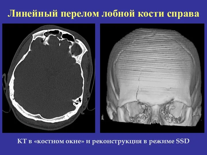 Линейный перелом лобной кости справа КТ в «костном окне» и реконструкция в режиме SSD