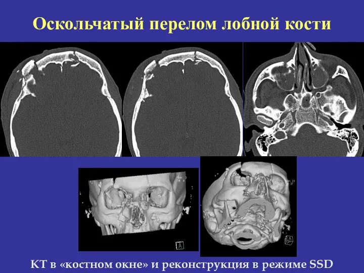 КТ в «костном окне» и реконструкция в режиме SSD Оскольчатый перелом лобной кости