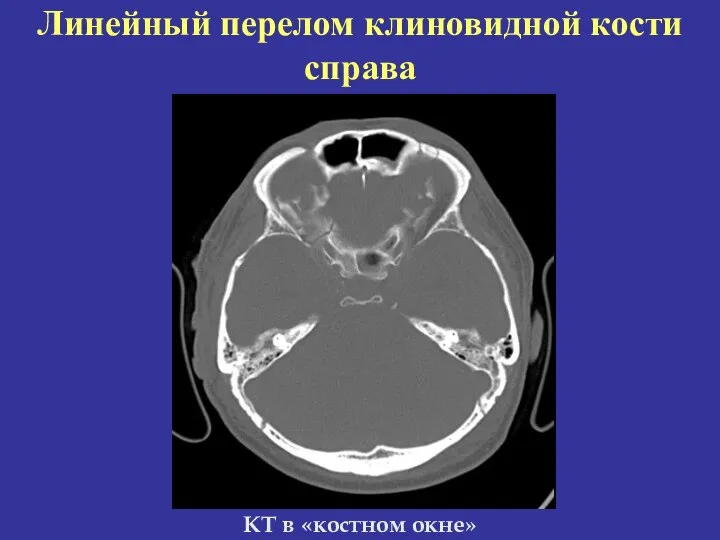 КТ в «костном окне» Линейный перелом клиновидной кости справа