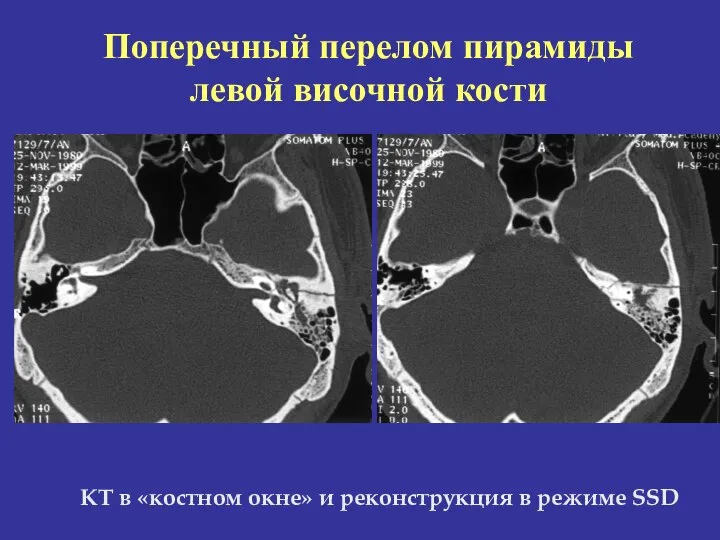 КТ в «костном окне» и реконструкция в режиме SSD Поперечный перелом пирамиды левой височной кости