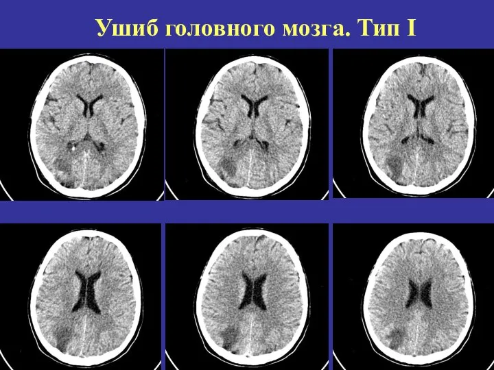 Ушиб головного мозга. Тип I