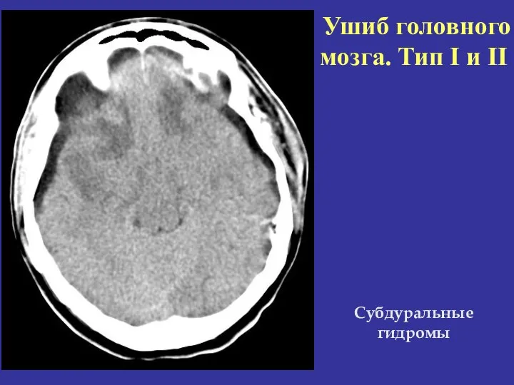 Ушиб головного мозга. Тип I и II Субдуральные гидромы