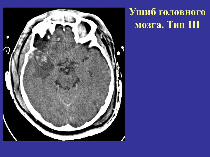 Ушиб головного мозга. Тип III