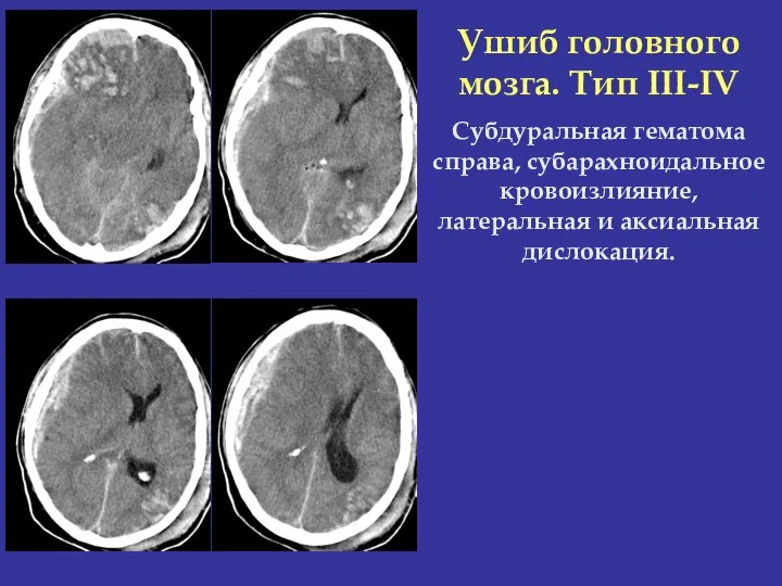 Ушиб головного мозга. Тип III-IV Субдуральная гематома справа, субарахноидальное кровоизлияние, латеральная и аксиальная дислокация.