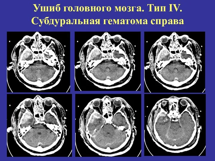 Ушиб головного мозга. Тип IV. Cубдуральная гематома справа