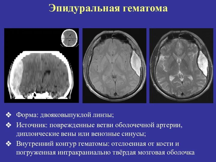 Эпидуральная гематома Форма: двояковыпуклой линзы; Источник: поврежденные ветви оболочечной артерии, диплоические