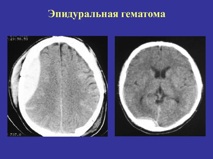 Эпидуральная гематома