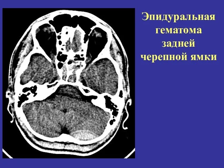 Эпидуральная гематома задней черепной ямки