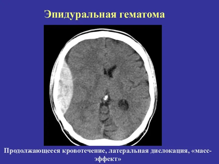 Продолжающееся кровотечение, латеральная дислокация, «масс-эффект» Эпидуральная гематома