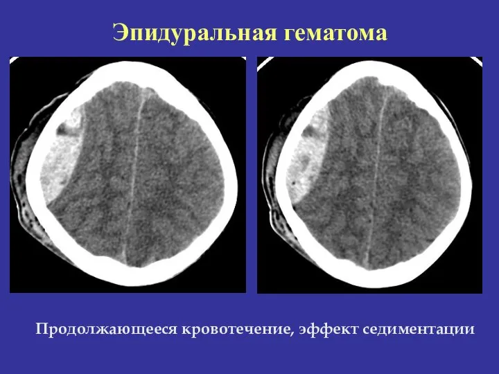 Продолжающееся кровотечение, эффект седиментации Эпидуральная гематома