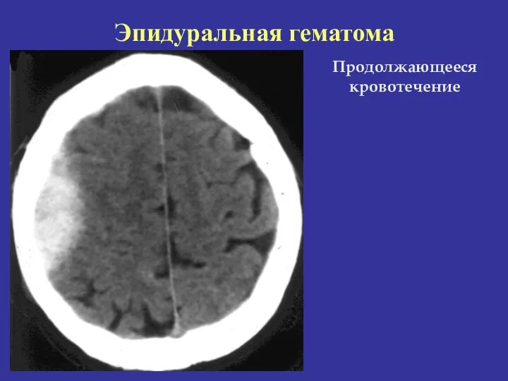 Продолжающееся кровотечение Эпидуральная гематома