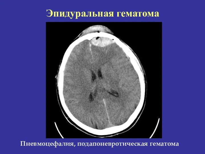 Пневмоцефалия, подапоневротическая гематома Эпидуральная гематома