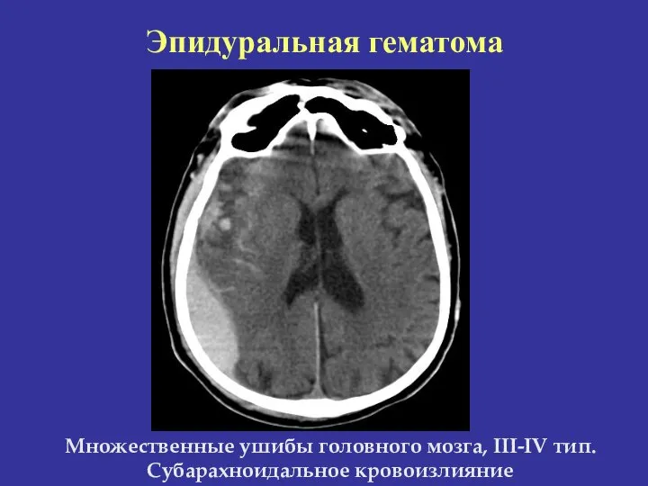 Множественные ушибы головного мозга, III-IV тип. Субарахноидальное кровоизлияние Эпидуральная гематома