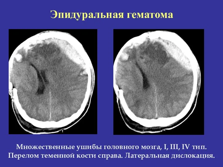 Множественные ушибы головного мозга, I, III, IV тип. Перелом теменной кости справа. Латеральная дислокация. Эпидуральная гематома