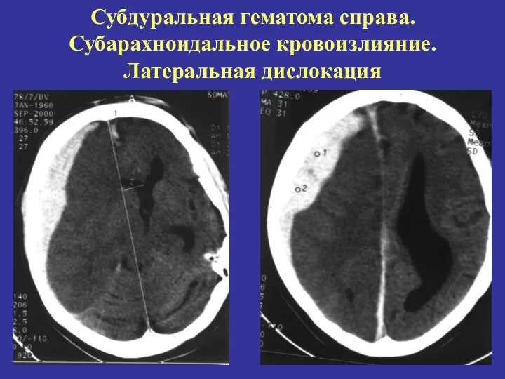 Субдуральная гематома справа. Субарахноидальное кровоизлияние. Латеральная дислокация