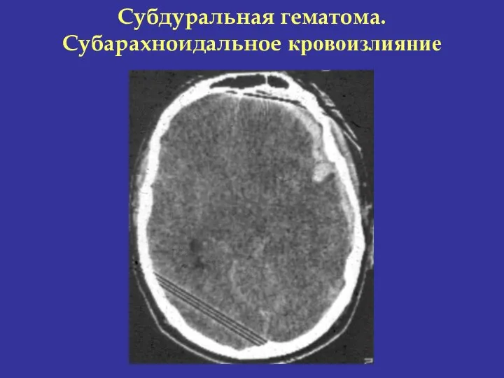 Субдуральная гематома. Субарахноидальное кровоизлияние