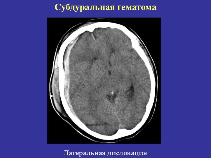 Субдуральная гематома Латеральная дислокация