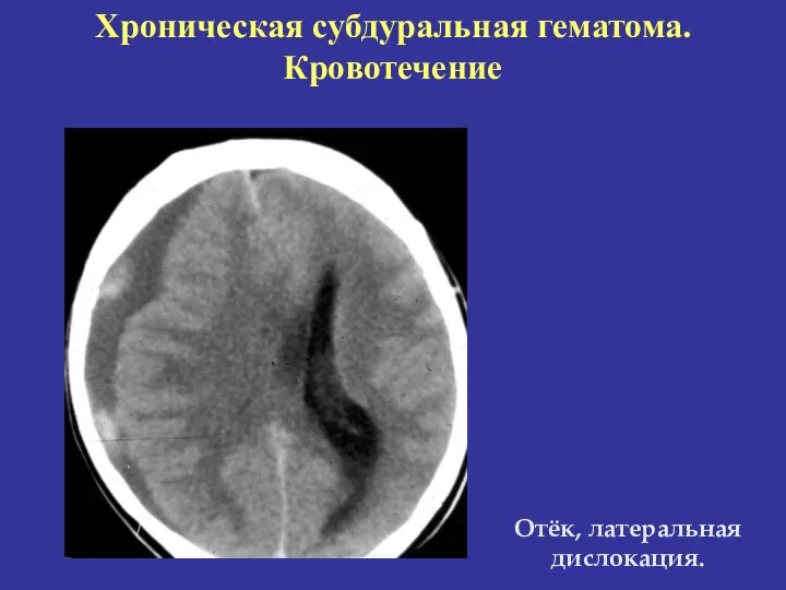 Хроническая субдуральная гематома. Кровотечение Отёк, латеральная дислокация.