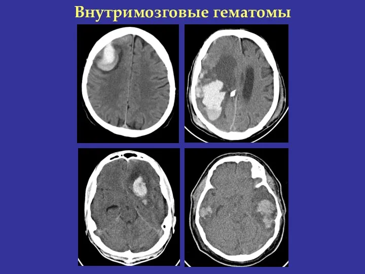 Внутримозговые гематомы