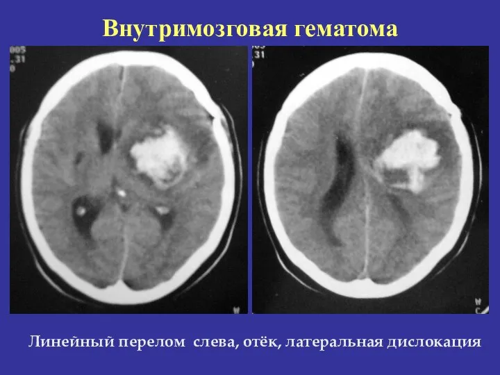 Внутримозговая гематома Линейный перелом слева, отёк, латеральная дислокация