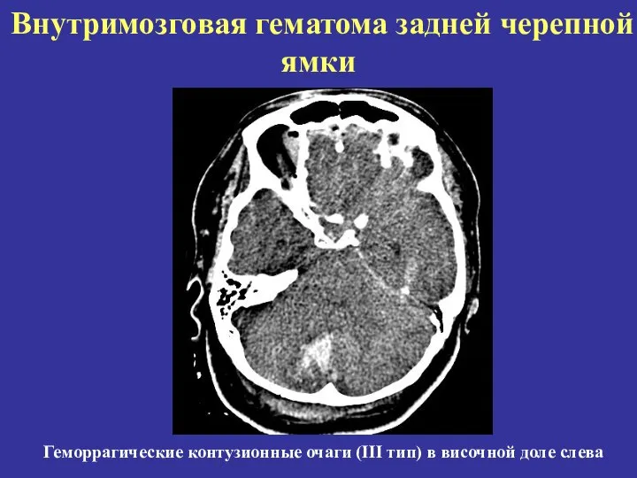 Внутримозговая гематома задней черепной ямки Геморрагические контузионные очаги (III тип) в височной доле слева