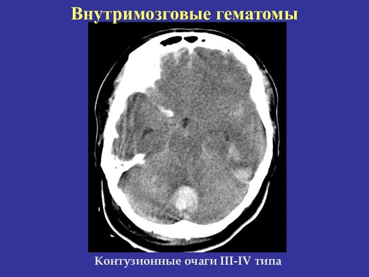 Внутримозговые гематомы Контузионные очаги III-IV типа