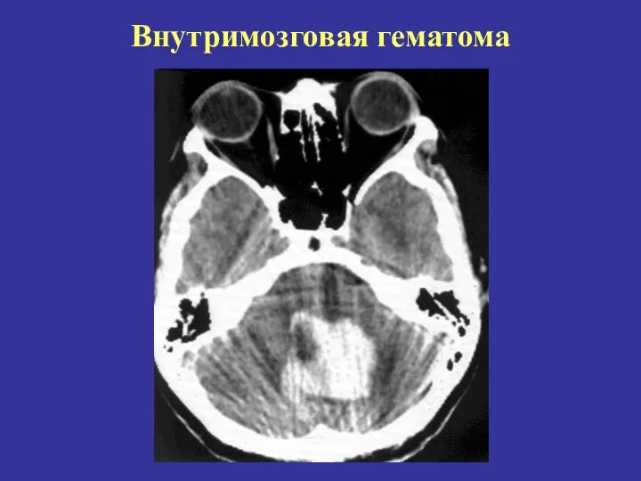 Внутримозговая гематома