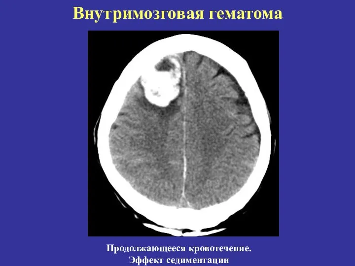 Внутримозговая гематома Продолжающееся кровотечение. Эффект седиментации