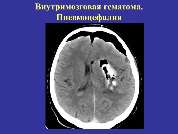 Внутримозговая гематома. Пневмоцефалия