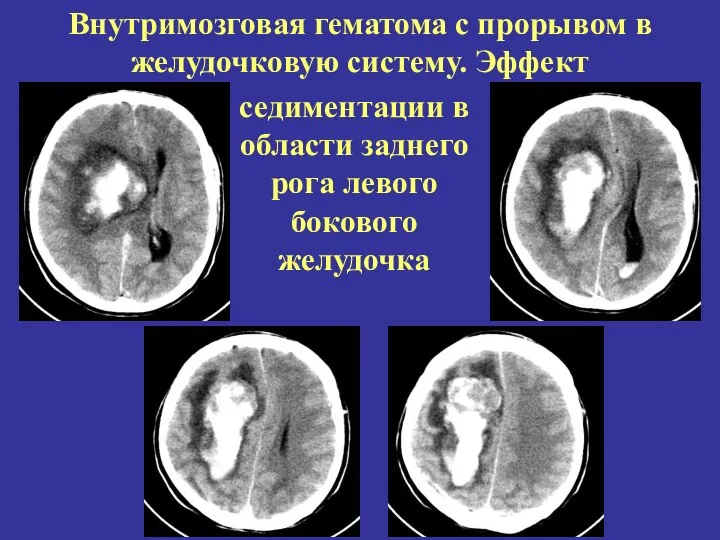 Внутримозговая гематома с прорывом в желудочковую систему. Эффект седиментации в области заднего рога левого бокового желудочка