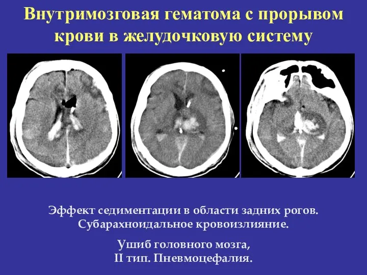 Внутримозговая гематома с прорывом крови в желудочковую систему Эффект седиментации в