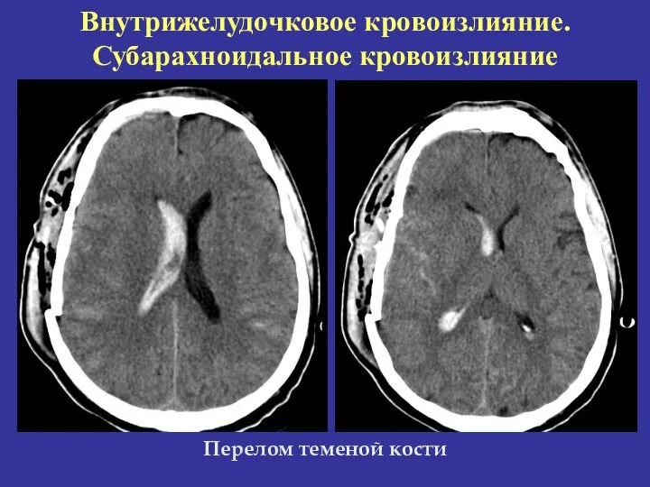 Внутрижелудочковое кровоизлияние. Субарахноидальное кровоизлияние Перелом теменой кости