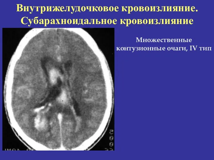 Внутрижелудочковое кровоизлияние. Субарахноидальное кровоизлияние Множественные контузионные очаги, IV тип