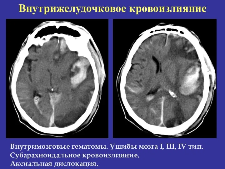 Внутрижелудочковое кровоизлияние Внутримозговые гематомы. Ушибы мозга I, III, IV тип. Субарахноидальное кровоизлияние. Аксиальная дислокация.