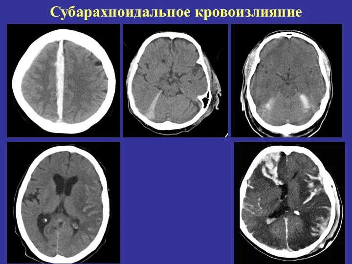 Субарахноидальное кровоизлияние