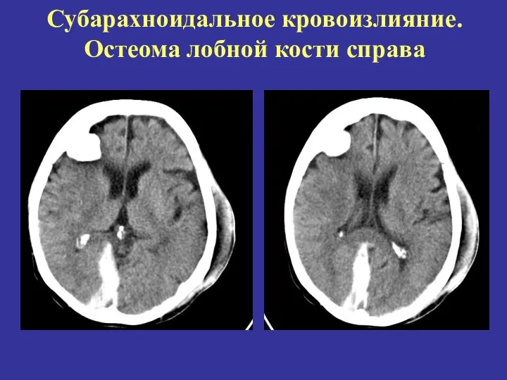 Субарахноидальное кровоизлияние. Остеома лобной кости справа