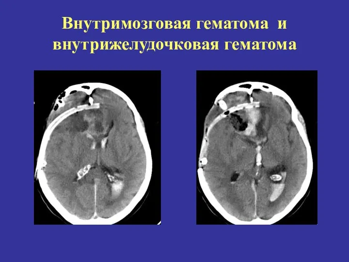 Внутримозговая гематома и внутрижелудочковая гематома