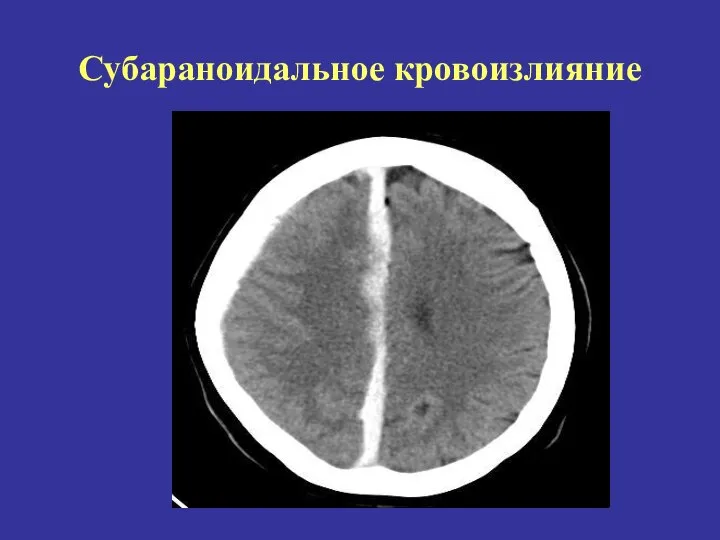 Субараноидальное кровоизлияние