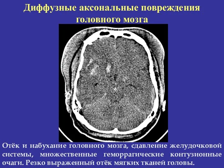 Диффузные аксональные повреждения головного мозга Отёк и набухание головного мозга, сдавление