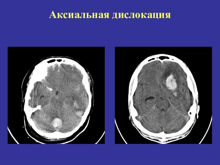 Аксиальная дислокация