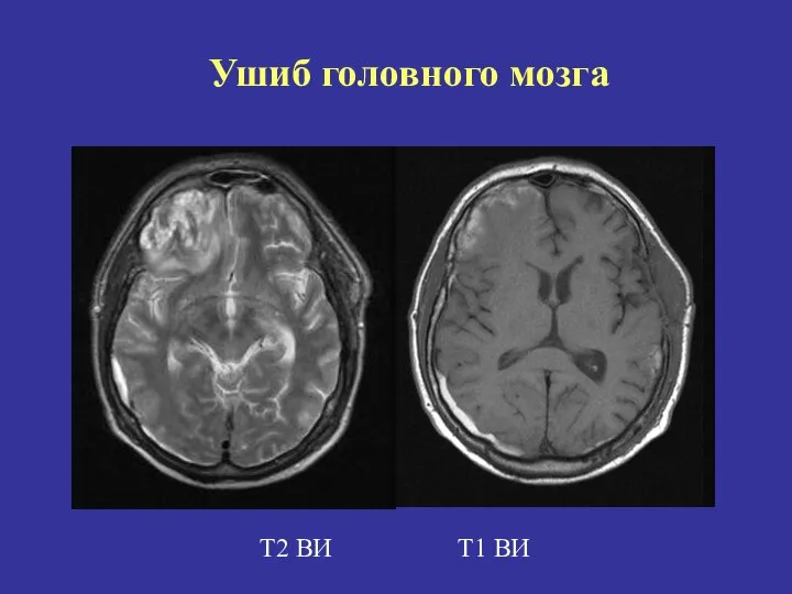 Т2 ВИ Т1 ВИ Ушиб головного мозга