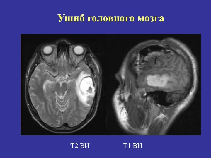 Т2 ВИ Т1 ВИ Ушиб головного мозга