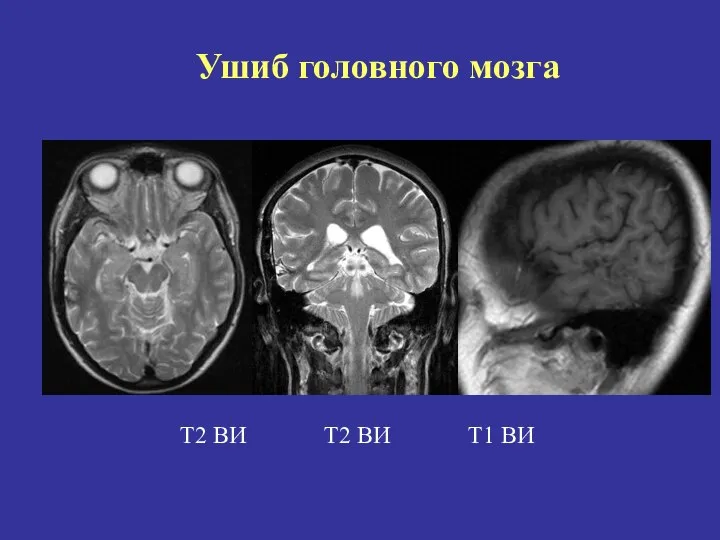 Т2 ВИ Т2 ВИ Т1 ВИ Ушиб головного мозга
