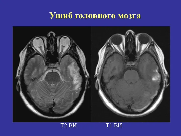 Т2 ВИ Т1 ВИ Ушиб головного мозга