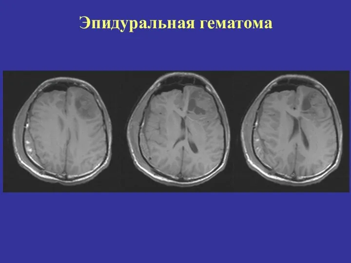 Эпидуральная гематома